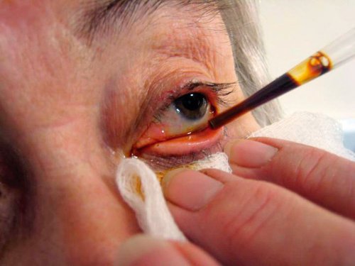 عینک صبا خشکی چشم