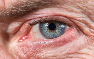 عینک صبا خشکی چشم